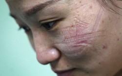 Hình ảnh y-bác sĩ "biến dạng" khuôn mặt vì dịch bệnh virus corona