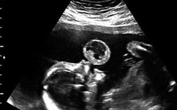 Lần đầu tiên trên thế giới mổ lấy u trong bào thai