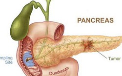 Vi khuẩn ngộ độc thức ăn giúp điều trị ung thư tụy