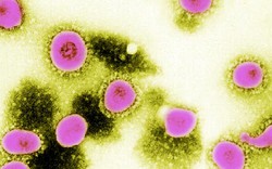 Arập Xêút: 5 người chết vì virus giống SARS