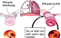 Khoảng 3,5 triệu người Việt Nam bị hen phế quản