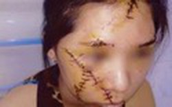 Nữ sinh 13 tuổi bị bạn rạch mặt vì ghen