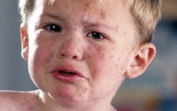 Cần đọc: Triệu chứng của bệnh sởi ở trẻ và cách điều trị