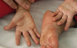Cảnh báo của Bộ Y tế về bệnh tay chân miệng 