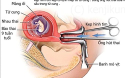 Có 1 triệu ca phá thai/năm