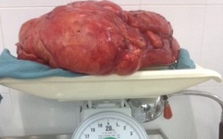 Cần Thơ: Nghe lời thầy lang để khối u trong bụng lớn đến 11kg