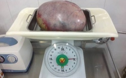 Cần Thơ: Phẫu thuật thành công u buồng trứng nặng 5kg