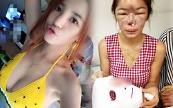 Hot girl Thái hóa “mặt quỷ” vì sự cố tiêm silicon 