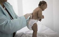 Khẳng định chắc chắn virus Zika gây ra chứng teo não