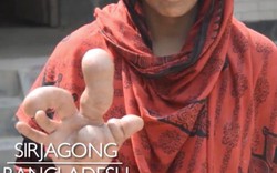 Bàn tay khổng lồ dị dạng của người phụ nữ Bangladesh