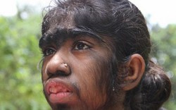 Bé gái “người sói” lông phủ kín toàn thân ở Bangladesh
