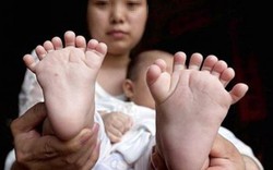 Bé trai ở Trung Quốc có 16 ngón chân