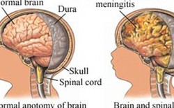 Trẻ sốt cao, đau đầu ngày nóng: Coi chừng viêm não do virus