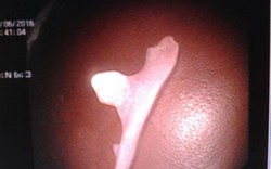 Nuốt cung hàm răng giả, nữ bệnh nhân suýt thủng dạ dày