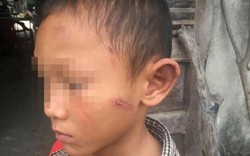 Bé trai 5 tuổi bị dì ruột bạo hành dã man