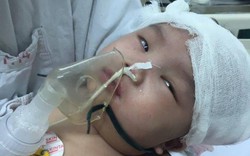 Ngã võng, bé gái 6 tháng tuổi bị chấn thương sọ não nguy kịch