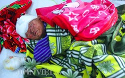 Em bé 4 tuổi bị bỏng nặng ở Lạng Sơn được lên tuyến trên điều trị