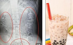 Trung Quốc: 100 hạt trân châu mắc kẹt trong bụng bé gái nghiện trà sữa