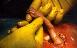 Thai nhi 21 tuần thò tay khỏi tử cung, nắm tay bác sĩ