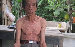 Người đàn ông Quảng Nam có hàng nghìn khối u