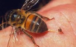 Bạc Liêu: Cứu sống bệnh nhân bị ong đốt 75 vết