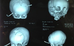 Bé 10 tháng tuổi bị thanh sắt đâm xuyên não được cứu sống kỳ diệu