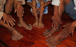 Bến Tre: Một gia tộc kỳ lạ có 24 ngón chân, tay