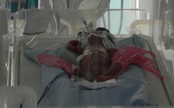 Bé sơ sinh suýt bị chôn sống được điều trị đặc biệt