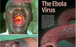 Phát hiện liều thuốc thần kỳ cho bệnh nhân nhiễm virus Ebola?