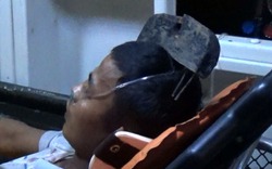 Người đàn ông nhập viện với chiếc cào sắt găm chặt trên đầu