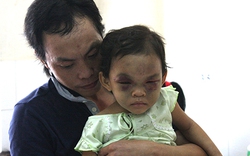 Bình Dương: Bé gái 3 tuổi bị bạo hành xuất viện, về ở với cha