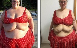 2 cô gái khốn khổ vì da thừa đáng sợ hậu giảm cân
