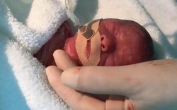 TQ: Cặp song sinh bé "bằng lòng bàn tay" chào đời