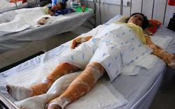 Bình Định: Xót lòng nhìn 3 mẹ con bị bỏng nặng do tai nạn giao thông