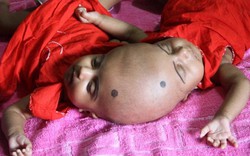 Cặp song sinh dính liền đỉnh đầu ở Bangladesh