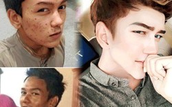 Sốc vì mặt mụn chi chít trước "dao kéo" của hot boy Malaysia