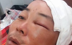 Đắk Lắk: Hai công an xã xô xát, một người bị chấn thương sọ não