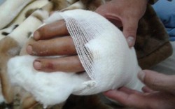 Lâm Đồng: Nối thành công bàn tay bị chém đứt lìa