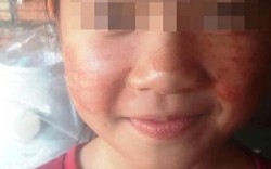 Lạ: Bé gái 11 tuổi mắc bệnh hiếm gặp, ra mồ hôi màu đỏ
