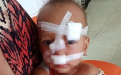 Bố mẹ cãi nhau, bé gái 2 tuổi nhập viện khâu 12 mũi