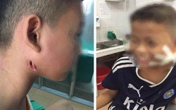 Phát hiện 3 trẻ ở Nghệ An nhiễm vi khuẩn ăn mòn cơ thể Whitmore