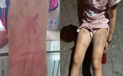 Vụ bé gái 6 tuổi bị bà đánh đập gây thương tích: “Đánh để giáo dục”