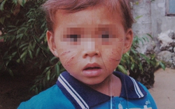 Quảng Ngãi: Bé trai 1 tuổi bị rạch mặt chằng chịt