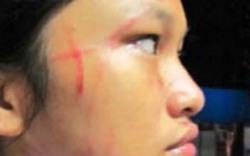 Nữ sinh lớp 8 bị phụ huynh đánh rách mặt
