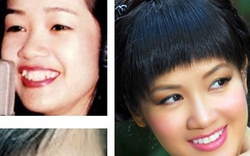 Những sao Việt &#34;lên đời&#34; nhan sắc nhờ chỉnh sửa răng