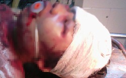 Bé gái 14 tuổi ở Thanh Hóa bị đánh dã man trong đêm tối