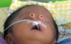 Video: Cậu bé không có mũi chào đời ở Peru