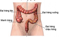 Hút thuốc lá làm tăng nguy cơ mắc ung thư trực tràng