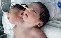 Em bé hai đầu chào đời ở Ấn Độ