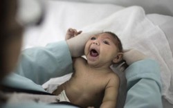 Bé gái bị bệnh đầu nhỏ ở Đắk Lắk không nhiễm virus Zika